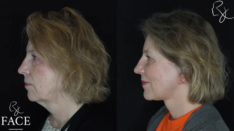 faceliftMar1sideleft