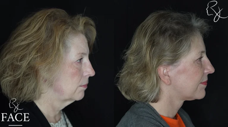 faceliftMar1sideright