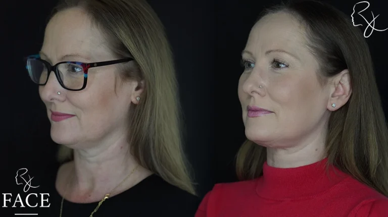 neckliftMar1sideangleleft