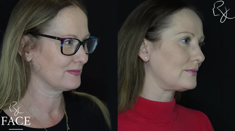 neckliftMar1sideangleright