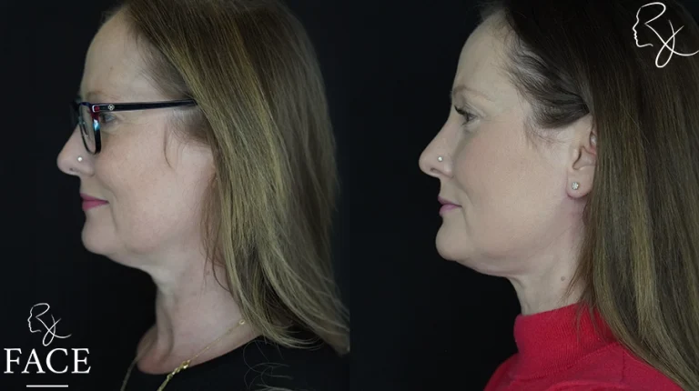 neckliftMar1sideleft