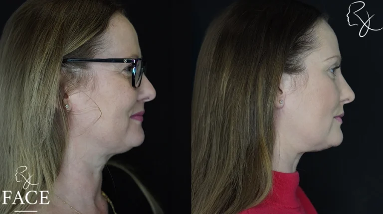 neckliftMar1sideright