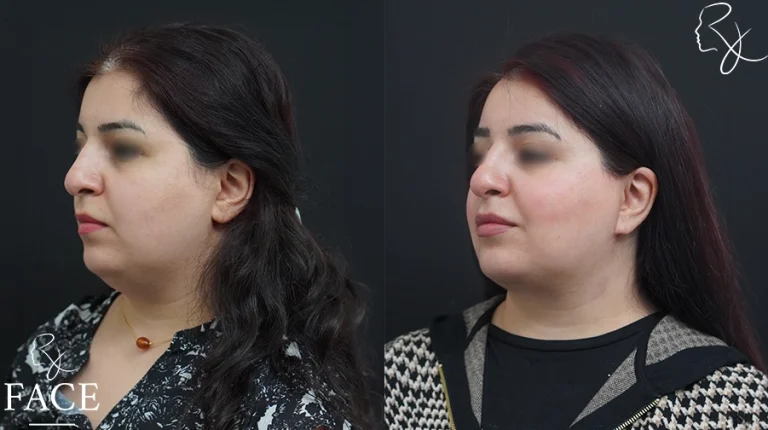 neckliftMar2sideangleleft