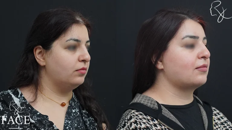 neckliftMar2sideangleright