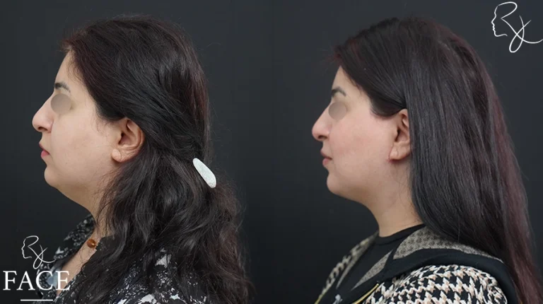 neckliftMar2sideleft