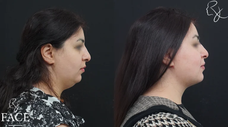 neckliftMar2sideright