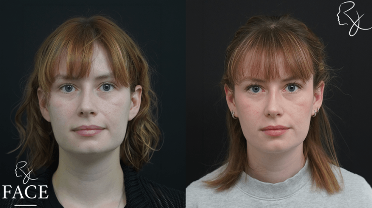 Olivia front beforeAfter