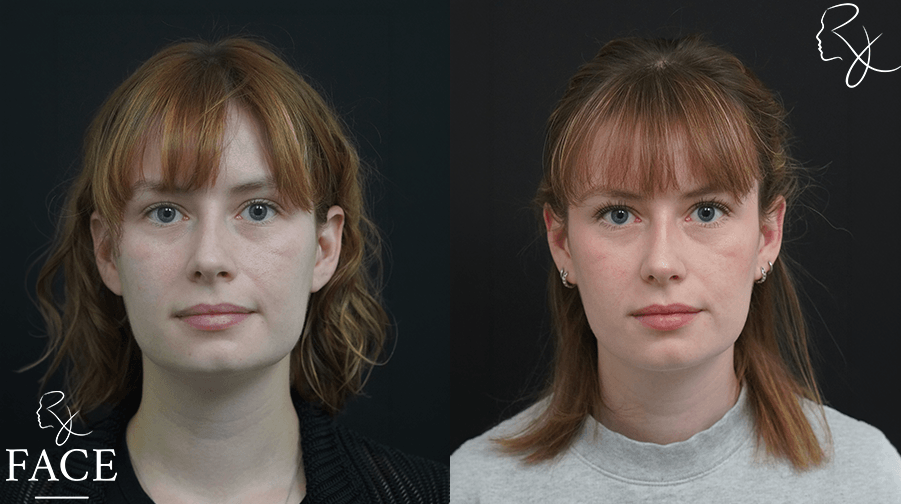 Olivia front beforeAfter