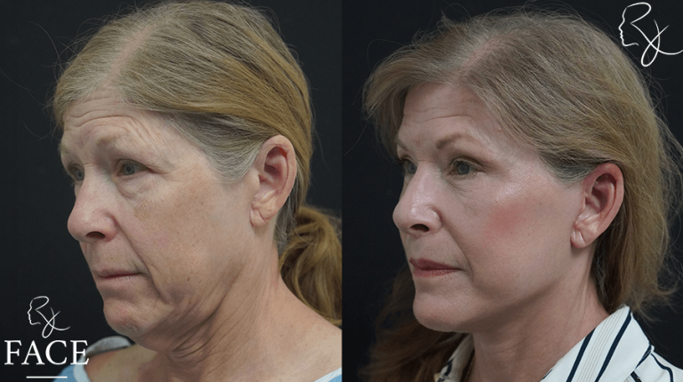 DLFaceliftLeftside