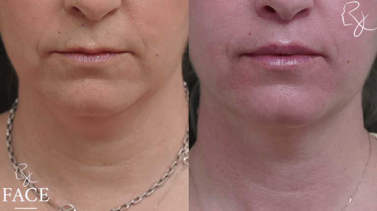 LR_lipliftFront