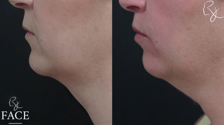 LR_lipliftLeftSide