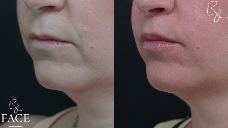 LR_lipliftLeftSidepart