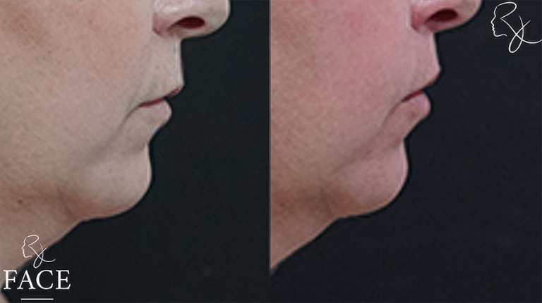 LR_lipliftRightSide
