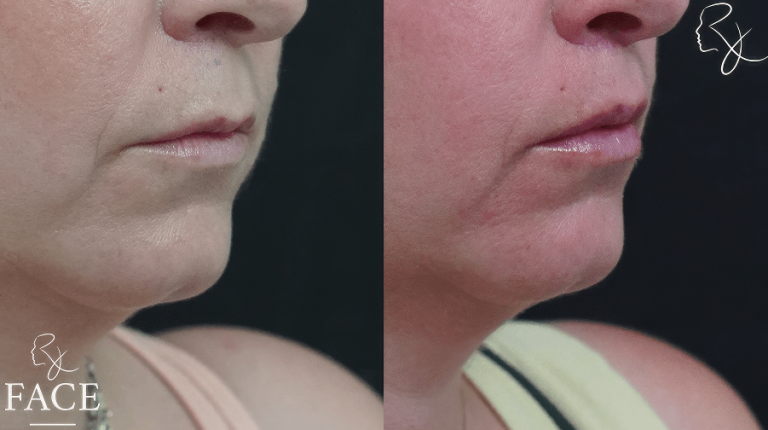 LR_lipliftRightSidepart