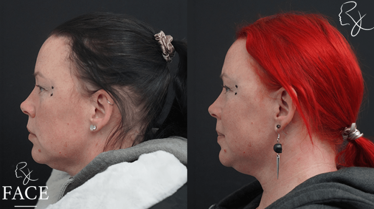 LSBrowBlephLeft
